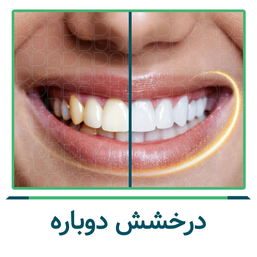 بلیچینگ دندان
