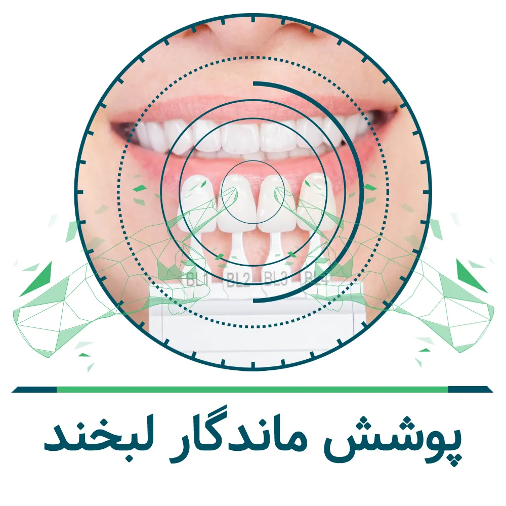 لمینت دندان